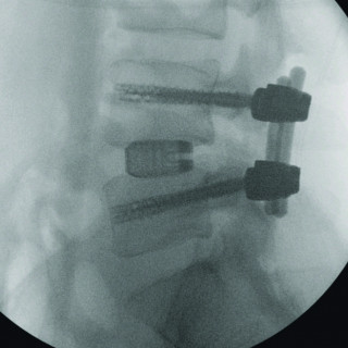 3D titán lumbal cage - BMD TLIF cage