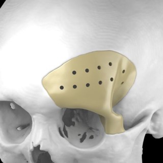 3D nyomtatott egyedi peek implantátumok - Recranio™