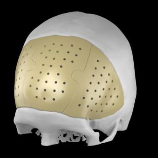 3D nyomtatott egyedi peek implantátumok - Recranio™