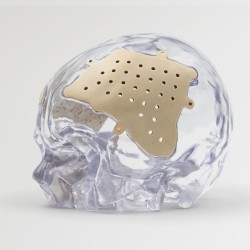 3D nyomtatott egyedi peek implantátumok - Recranio™