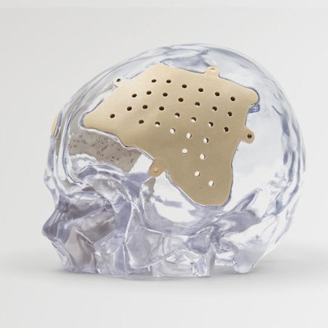 3D nyomtatott egyedi peek implantátumok - Recranio™