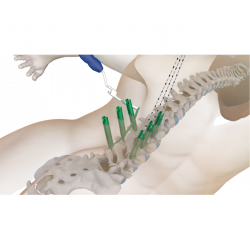 MIS-gerinc implantátumok